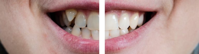 Alignertherapie vorher/nachher
