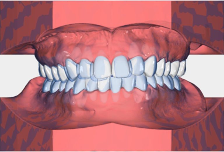 Aligner Therapieplan im 3D Webbetrachter zur Korrekturabsprache vor Produktionsbeginn der Alignerschienen, Übertragungsschlüssel/Attachments